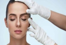 Blepharoplasty
