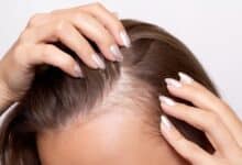 Thinning Hair